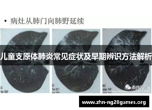 儿童支原体肺炎常见症状及早期辨识方法解析 儿童支原体肺炎常见症状及早期辨识方法解析